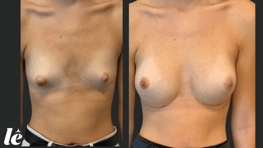 Correction de seins tubéreux par augmentation mammaire et injections de graisse