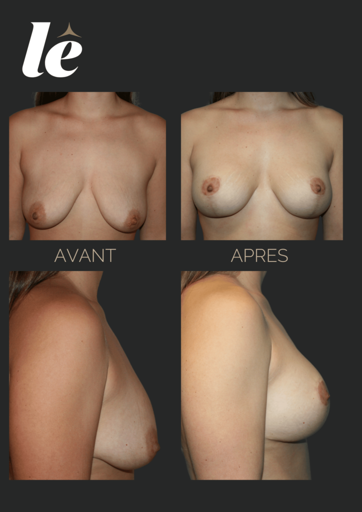 augmentation mammaire et lifting (mastopexie)