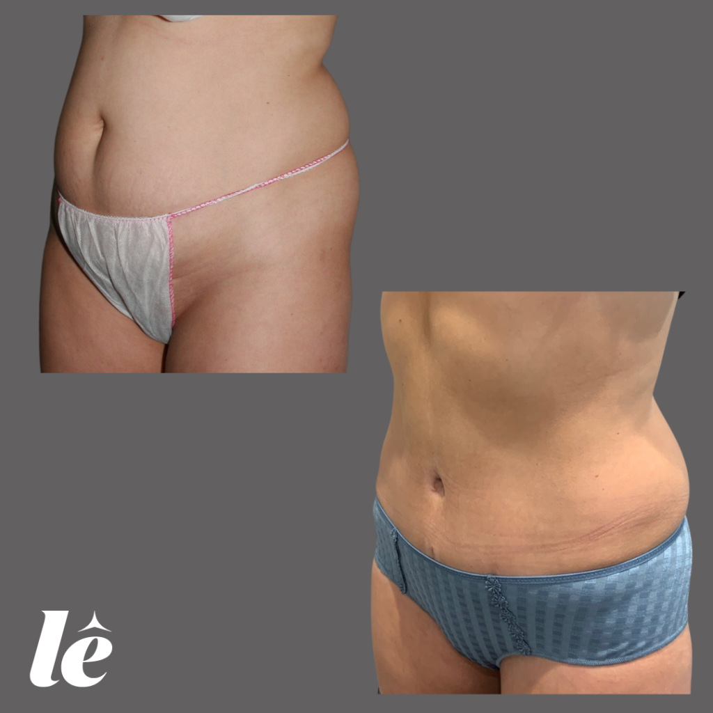 Lipoaspiration, Abdominoplastie et Correction du Diastasis des muscles abdominaux après grossesses